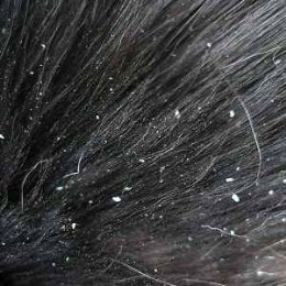 scalp condition - dandruff